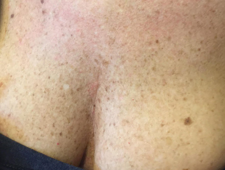 Ringiovanimento viso collo e decolleté