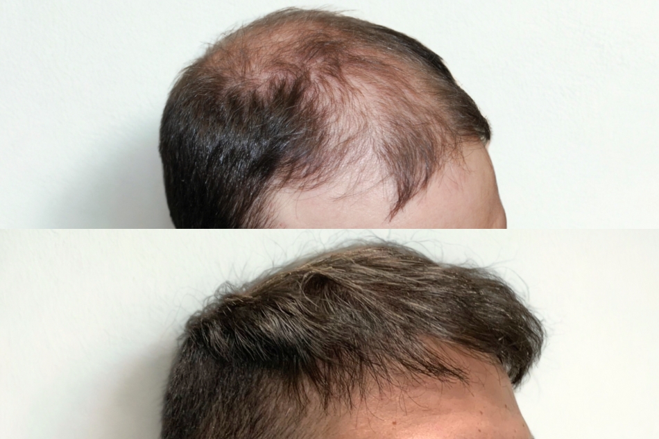 I tuoi capelli stanno diventando un deserto? Scegli il Trapianto Capelli con la qualità italiana