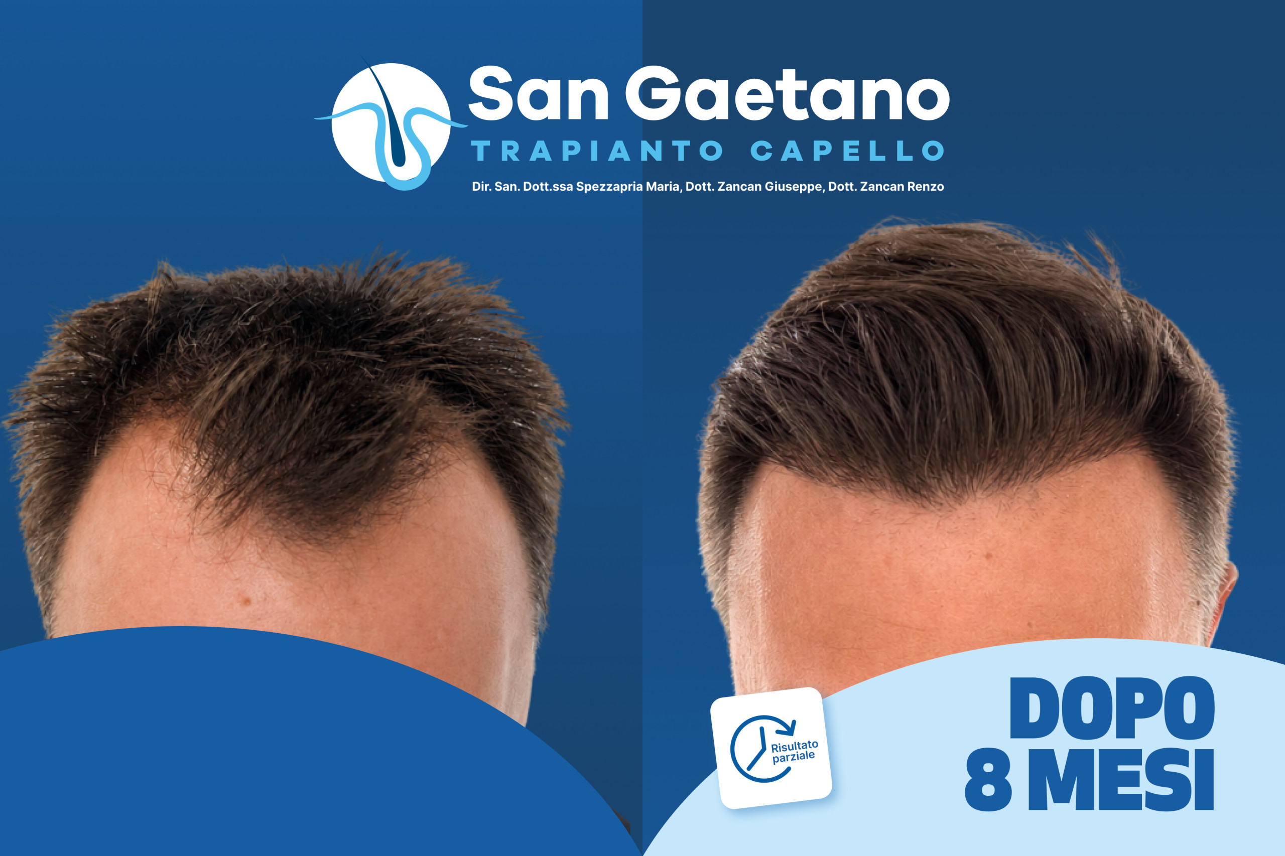 Trapianto Capello San Gaetano con tecnica FUE - Thiene Vicenza