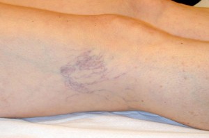 Vene varicose: conoscerle per curarle