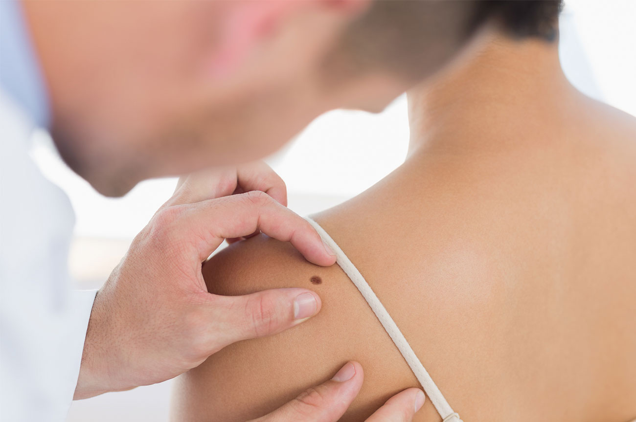 Il Melanoma: diagnosi precoce grazie alla Videodermatoscopia digitale