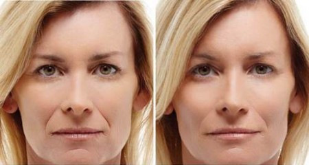 filler acido ialuronico estetica buratto filler acido ialuronico estetica buratto