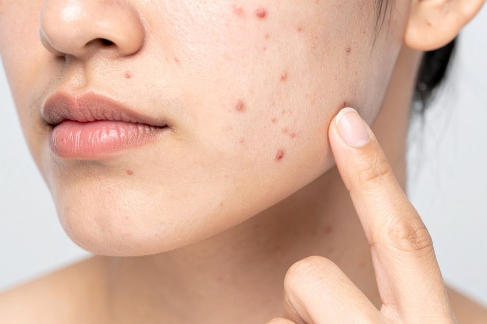 acne adulti visita dermatologica thiene schio vicenza