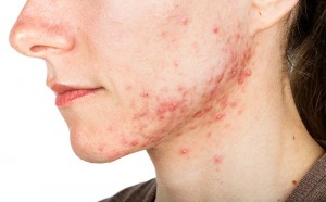 Acne? Curarla con la Terapia Biofotonica – Intervista al Dott. Bordignon