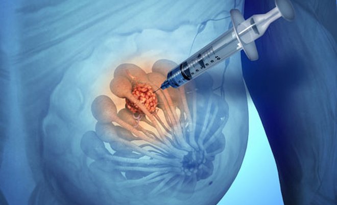 agoaspirato - thiene vicenza