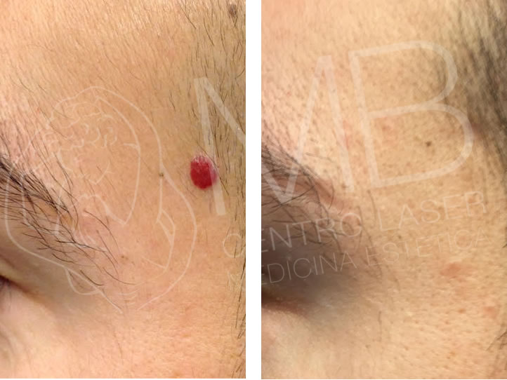 trattamenti laser angioma
