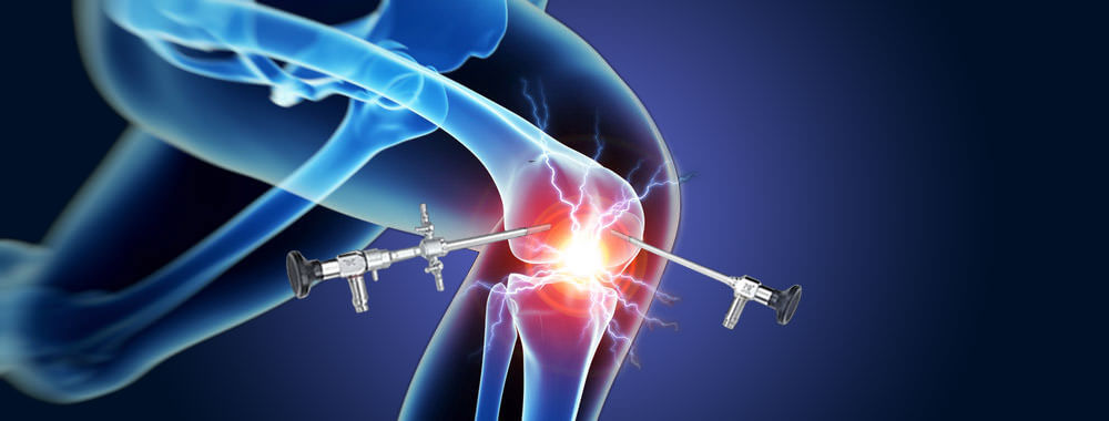 artroscopia del ginocchio