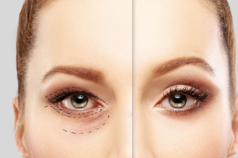 blefaroplastica thiene vicenza