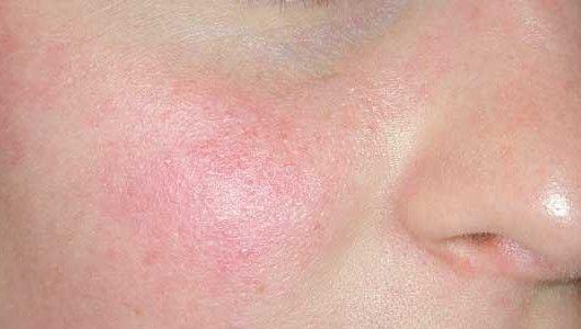 Couperose, cosa è e come si cura Couperose, cosa è e come si cura