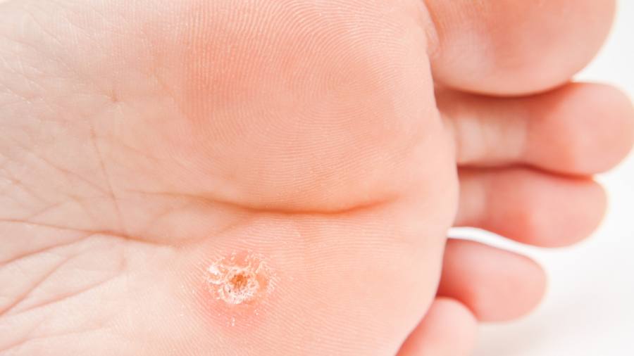 Crioterapia dermatologica: quando è indicata? Quali i vantaggi?