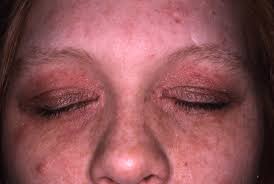 Dermatite Atopica