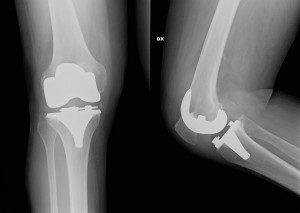 Dolore al ginocchio? Possibili cause e soluzioni