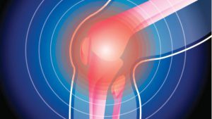 rottura menisco dolore