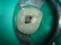 endodonzia studio dentistico spezzapria zancan