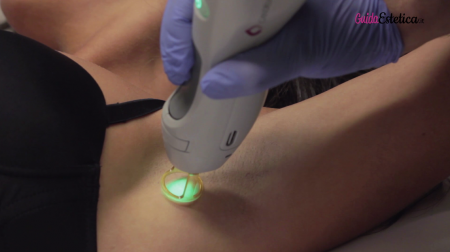 depilazione definitiva estetica buratto