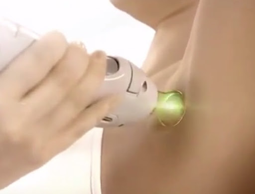 Epilazione laser: perché il centro medico è meglio di quello estetico? Epilazione laser: perché il centro medico è meglio di quello estetico?