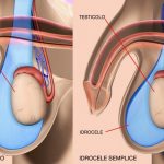 hydrocele thiene schio vicenza