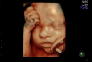 ecografia ginecologica ostetrica voluson