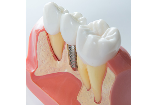 implantologia studio dentistico spezzapria zancan