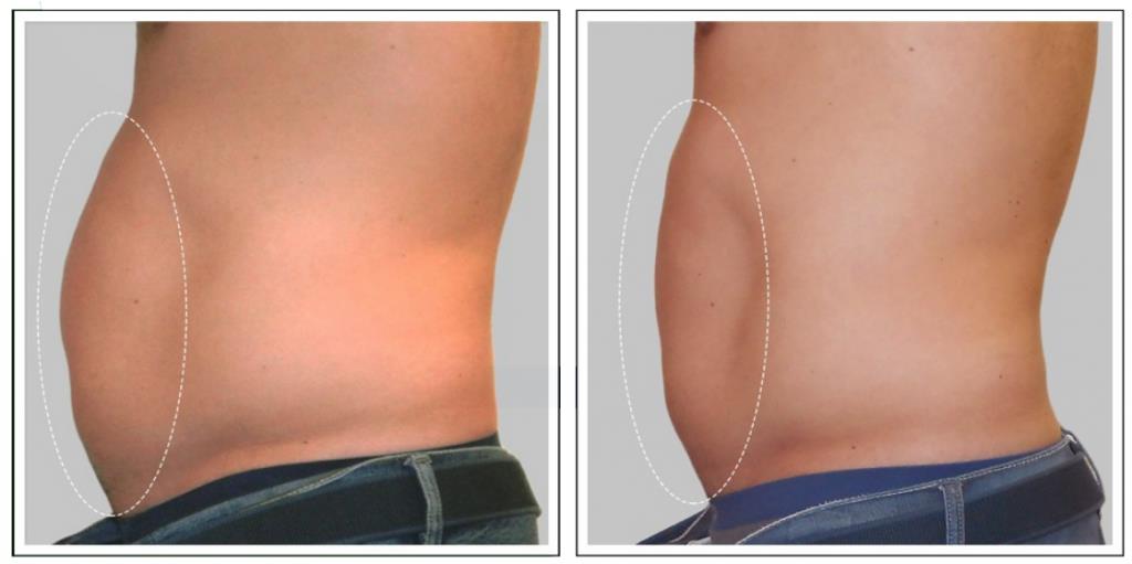 in forma per l estate estetica buratto 2