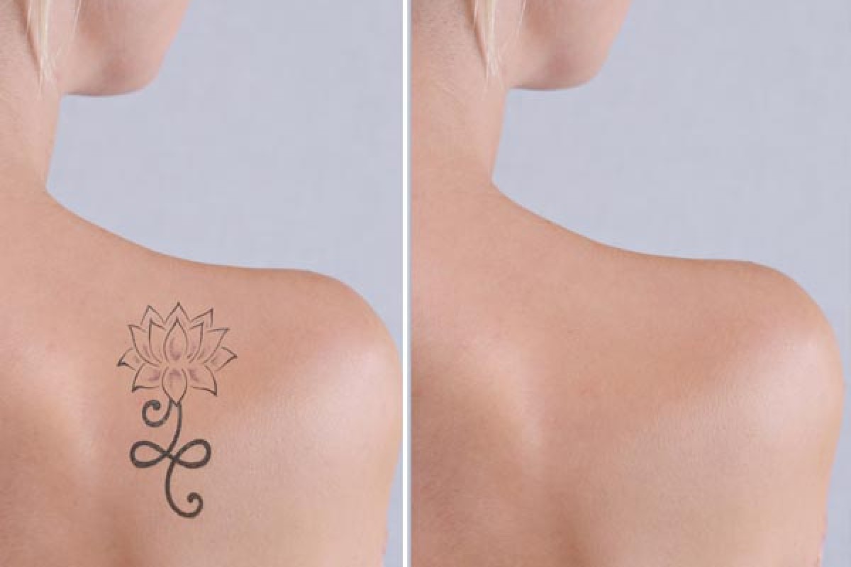 Rimuovere I Tatuaggi In Modo Sicuro Ed Efficace Con Picolaser Q Switched Poliambulatori San Gaetano