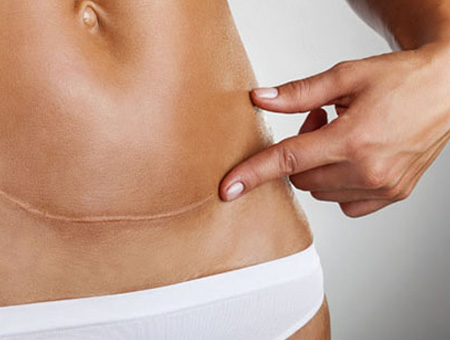 laserterapia Cicatrici post-operatorie