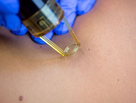laserterapia Resurfacing