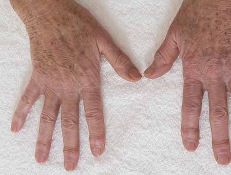 Ringiovanimento mani: scopriamo insieme la laserterapia