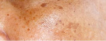 Macchie cutanee: prevenzione e trattamento Macchie cutanee: prevenzione e trattamento