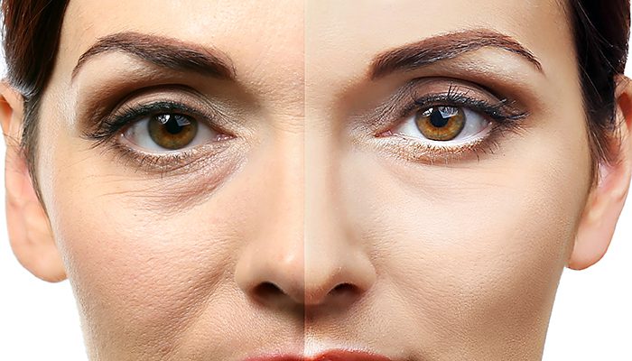 Addio alle occhiaie con la carbossiterapia