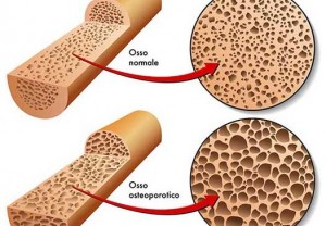 densitometria osteoporosi