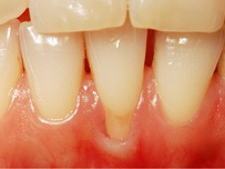 paradontologia studio dentistico spezzapria zancan