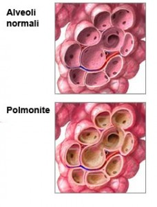 polmonite come capire