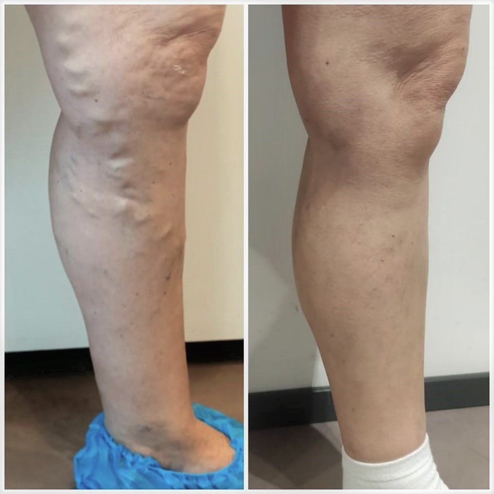 prima dopo vene varicose thiene schio vicenza a