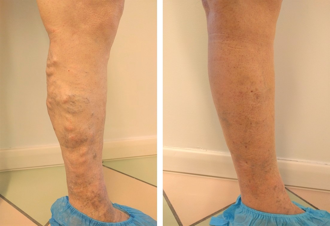 prima dopo vene varicose thiene schio vicenza c