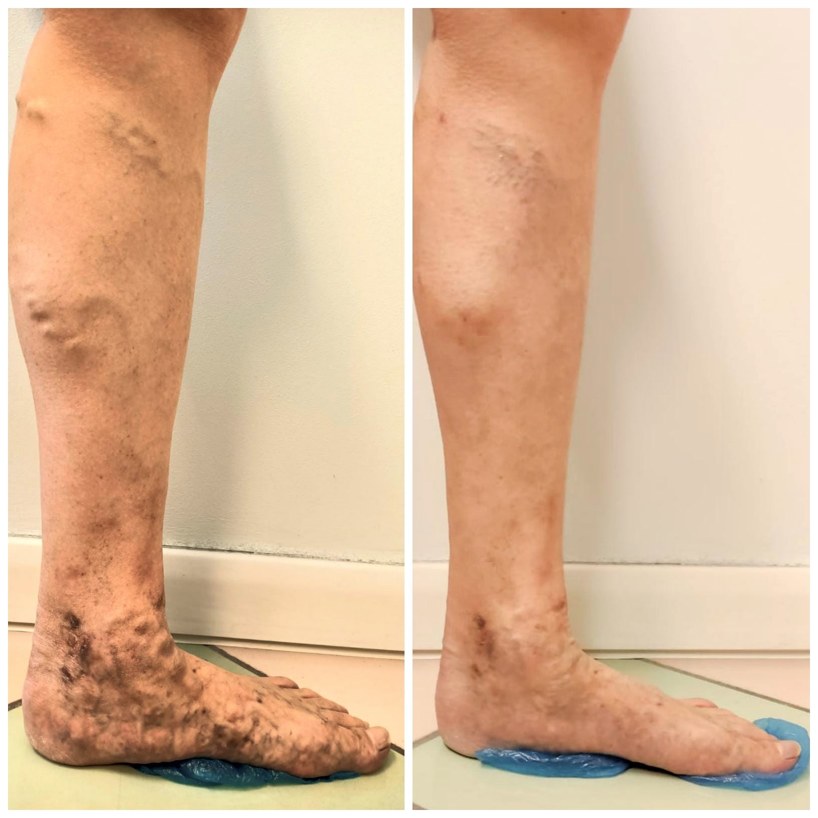 prima dopo vene varicose thiene schio vicenza d