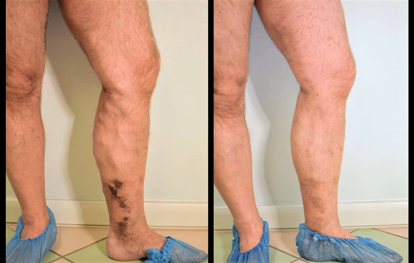 prima dopo vene varicose thiene schio vicenza e