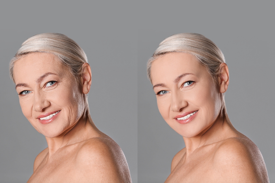 prima e dopo lipofilling poliambulatori san gaetano