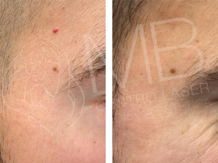 trattamenti laser angioma