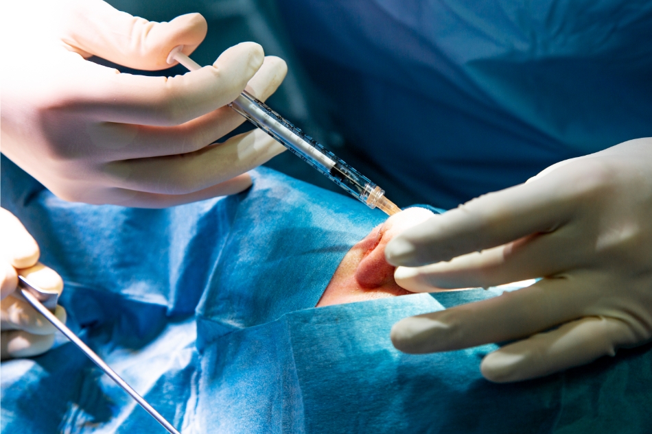 rimozione rinofima thiene schio vicenza