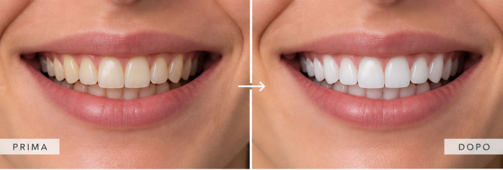 sbiancamento dentale professionale Thiene
