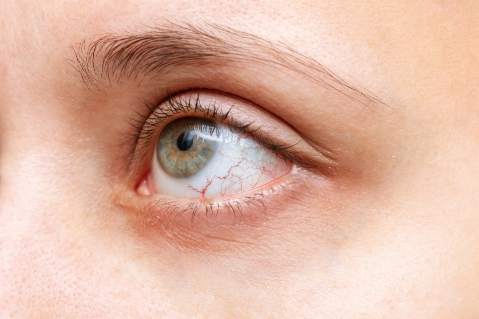 Occhi che bruciano, lacrimano o si affaticano? Potrebbe essere sindrome dell’occhio secco