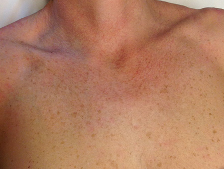 Lunguento di zinco per candeggiare di pelle di faccia