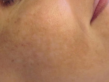 trattamento laser Melasma