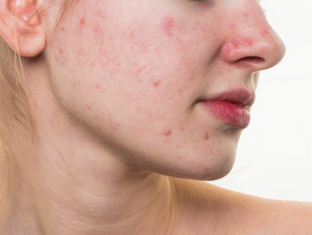 trattamento laser rosacea