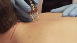 Macchie solari: rimuoverle da viso, spalle e decolette