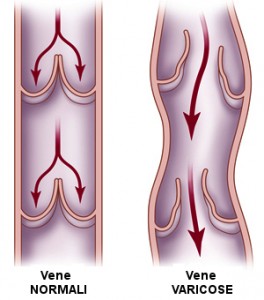 vene varicose cura